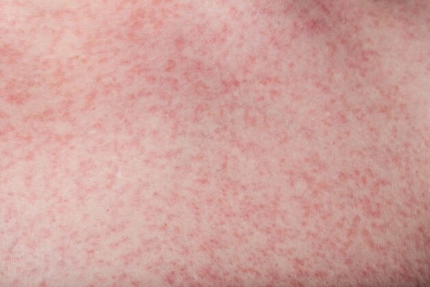 Sốt xuất huyết ở dưới da: Nguyên nhân và cách điều trị