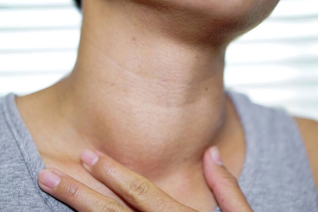 Biểu hiện suy tuyến giáp ở người bệnh.