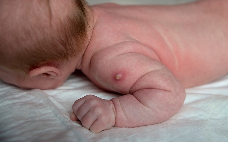 Quầng đỏ và loét nhẹ tại chỗ tiêm là phản ứng bình thường sau tiêm lao