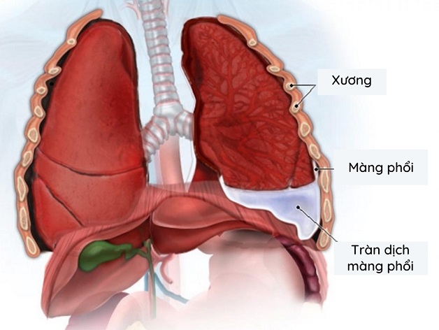 Xơ gan tràn dịch màng phổi là gì?