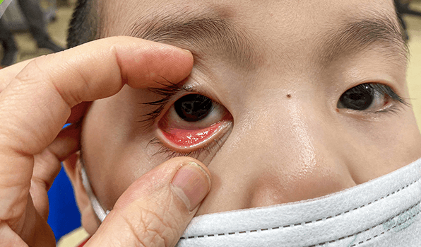 triệu chứng đau mắt đỏ