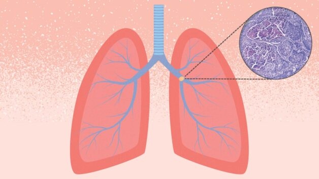 Triệu chứng ung thư phổi giai đoạn đầu