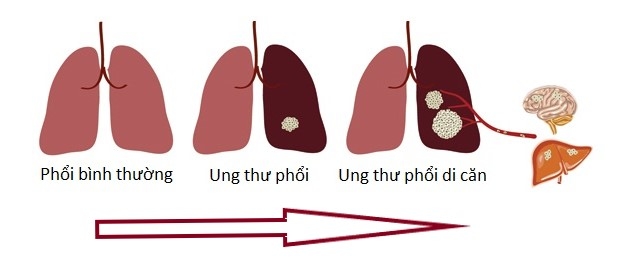 Giải đáp câu hỏi thường gặp về ung thư phổi giai đoạn di căn