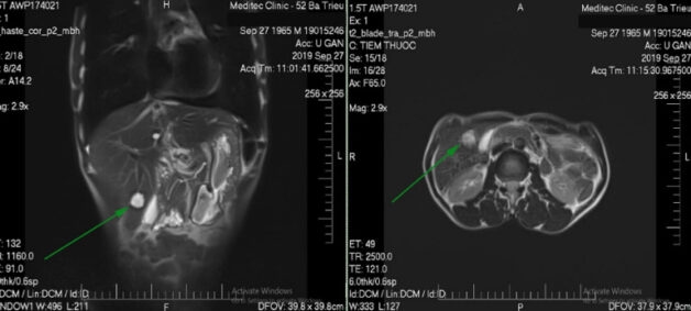 Hình ảnh kết quả MRI tuyến thượng thận