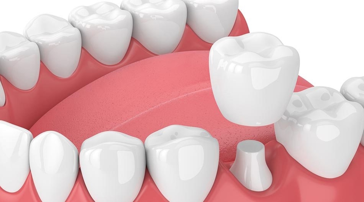 Độ tuổi có thể bọc răng sứ