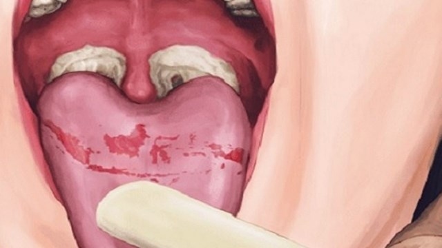 Biến chứng của bệnh bạch hầu 