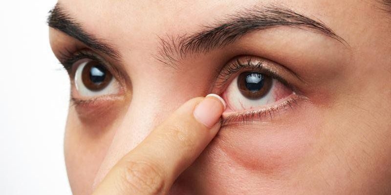 Người bệnh có thể bị đau mắt đỏ ở một hoặc cả hai mắt