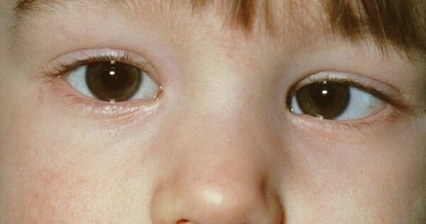 Không chữa mắt lé điều gì sẽ xảy ra?