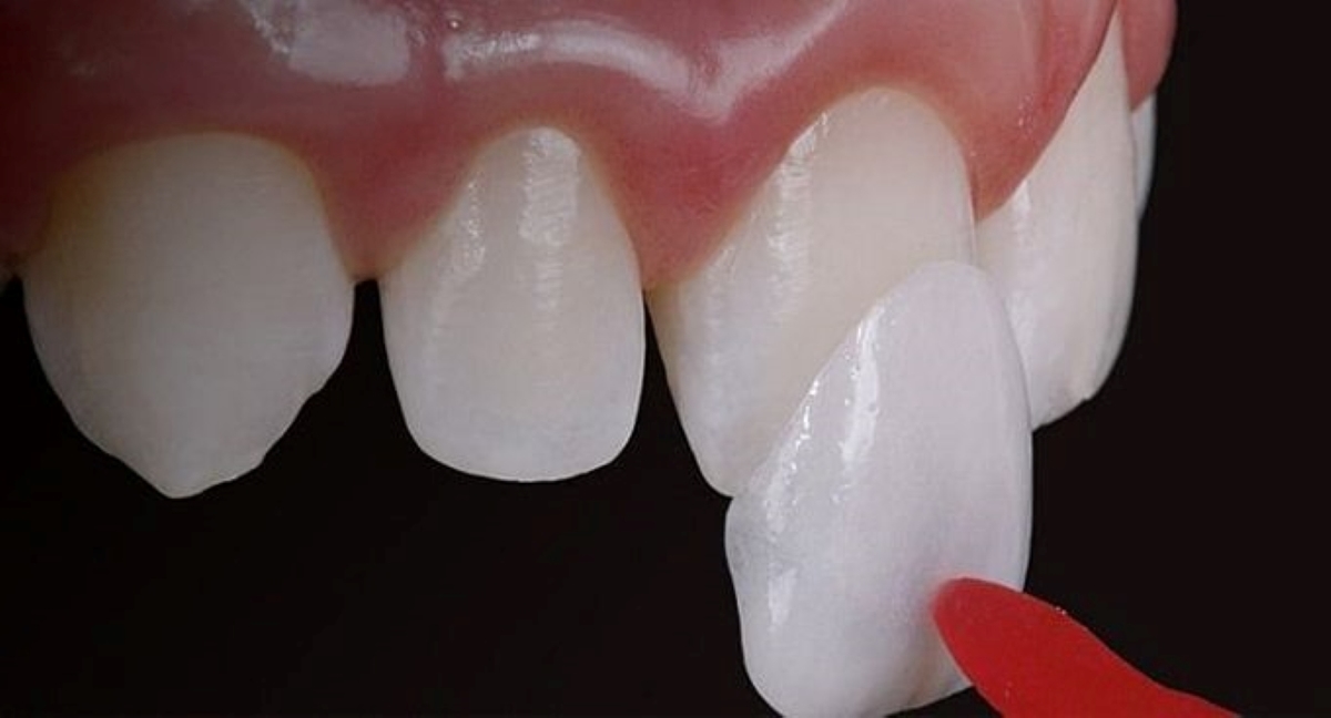 Bỏ túi địa chỉ dán sứ Veneer uy tín