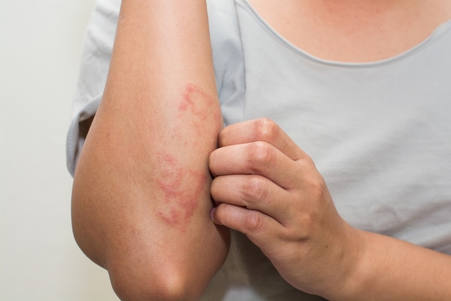 Những dấu hiệu ung thư máu điển hình cần biết