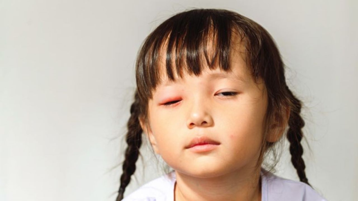 Có phải đau mắt đỏ ở trẻ em thường nhẹ hơn người lớn?