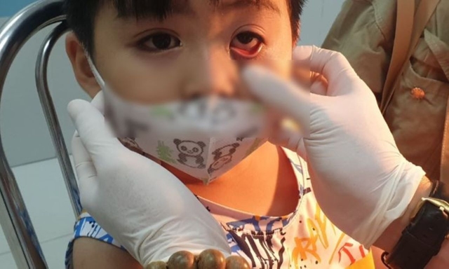 6 Nguyên nhân mắt bị đỏ một bên nhưng không đau