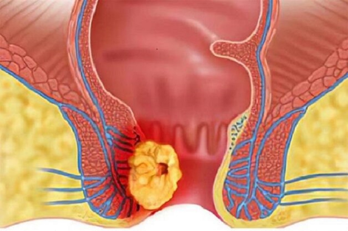 Phòng chống bệnh trĩ: Những biện pháp hiệu quả