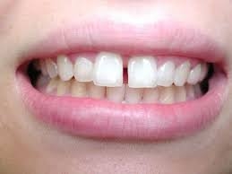 phục hình răng thưa