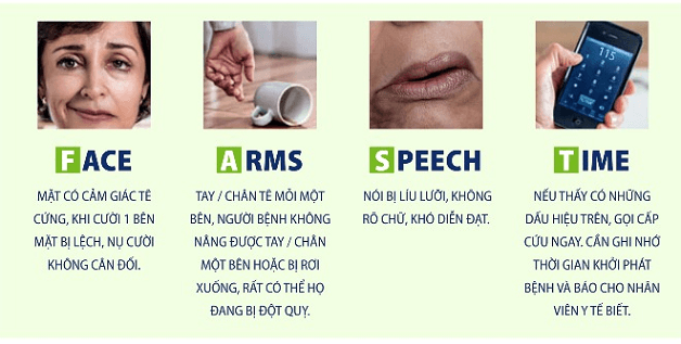 Dấu hiệu nhận biết bệnh đột quỵ có thể thông qua quy tắc F.A.S.T