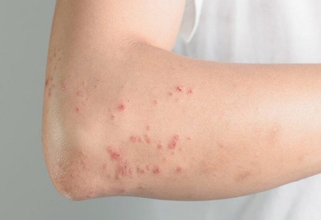 Phát ban, sẩn ngứa là một trong những triệu chứng sốt xuất huyết