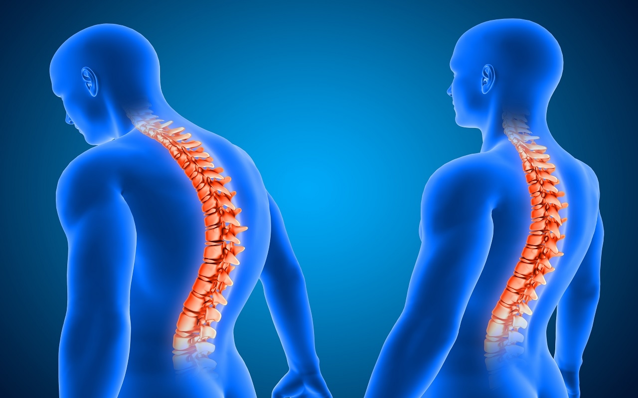 Vì sao bị loãng xương và giải pháp phòng ngừa