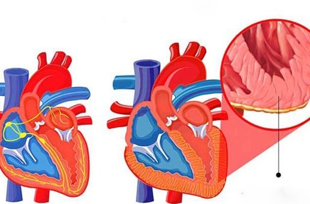 Điều trị thấp tim 