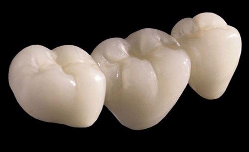 bọc răng sứ đắt không