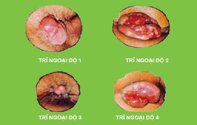 Hình ảnh các cấp độ của bệnh trĩ ngoại
