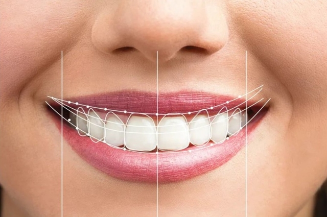 Thông tin về chi phí phẫu thuật cười hở lợi