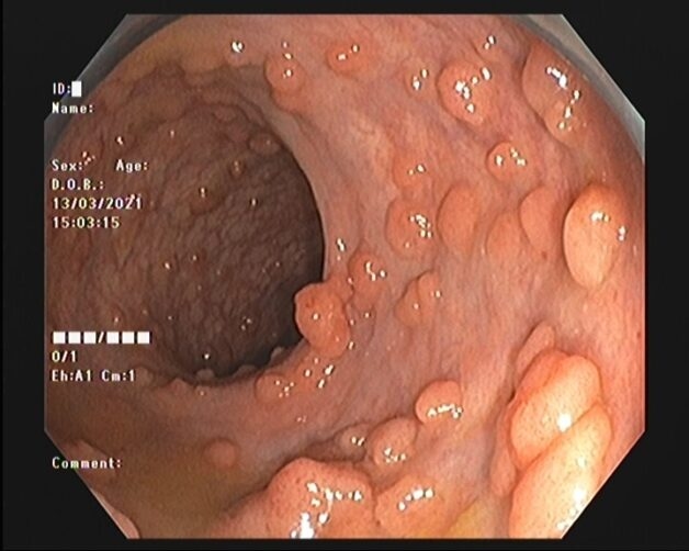 Hình ảnh đa polyp đại tràng gia đình