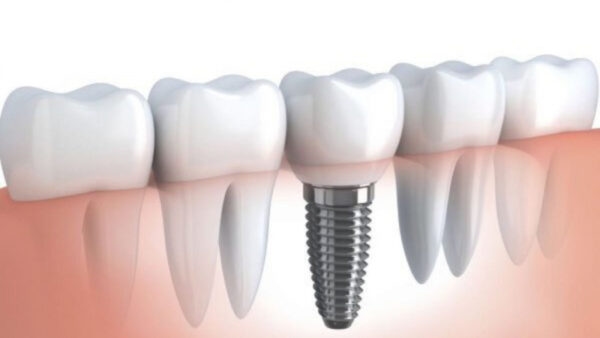 địa chỉ cấy ghép implant tốt