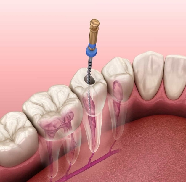 điều trị tủy răng cho bà bầu