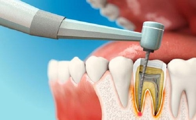 điều trị tủy răng