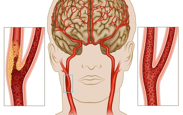 đột quỵ và tình trạng giảm tuổi thọ