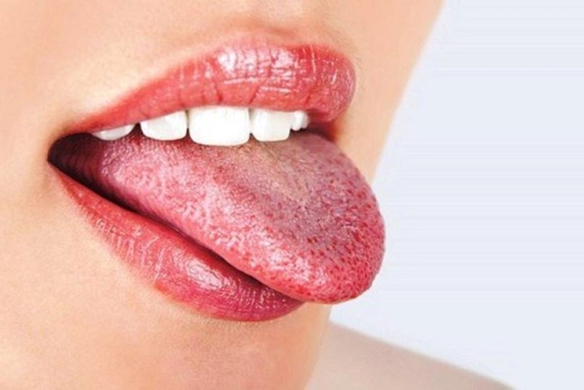 Bệnh nhân nấm miệng nên ăn gì và không nên ăn gì?