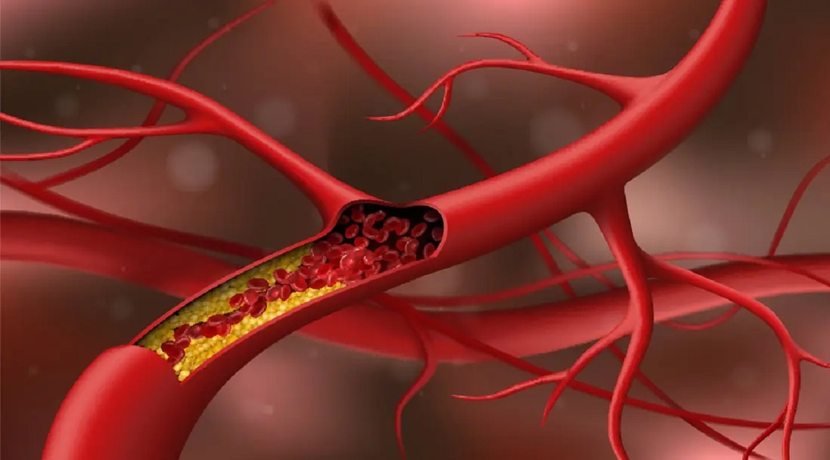 Nguy cơ đột quỵ não do không kiểm soát tốt cholesterol xấu