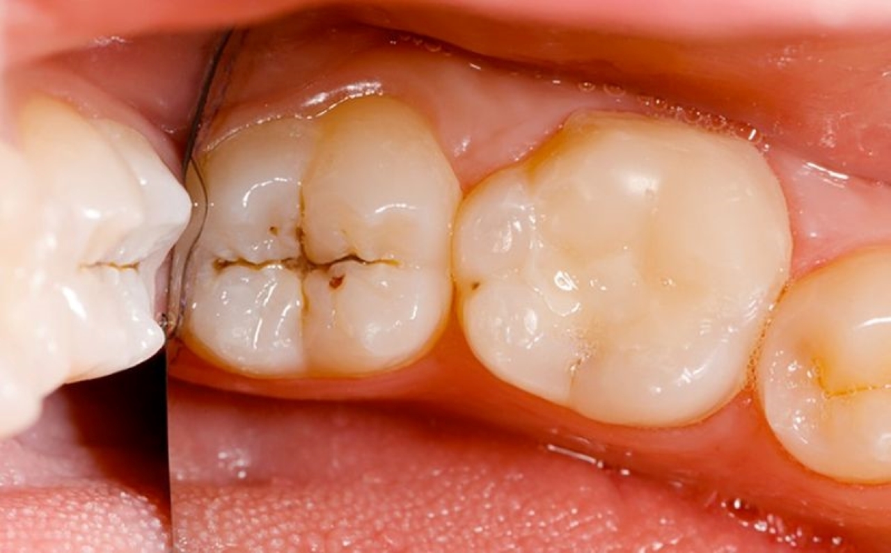 Răng cấm bị sâu và cách điều trị