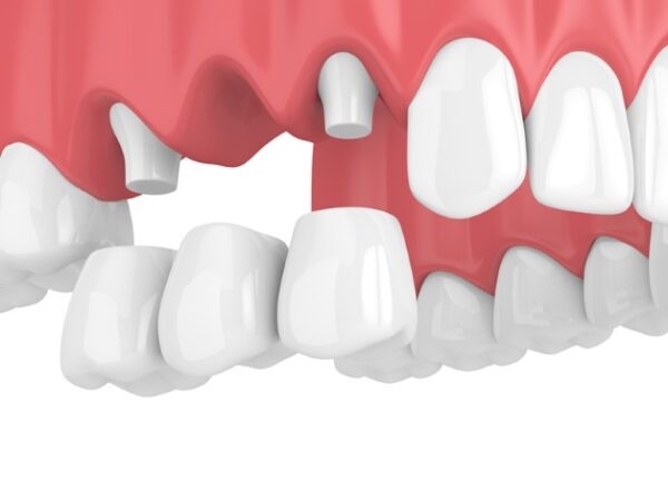 Bọc sứ sau khi điều trị sâu răng cấm giúp bảo đảm tính thẩm mỹ và chức năng ăn nhai