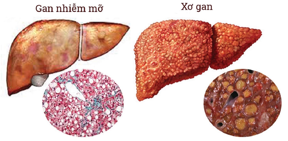 Rối loạn gan nhiễm mỡ: Những đối tượng dễ mắc