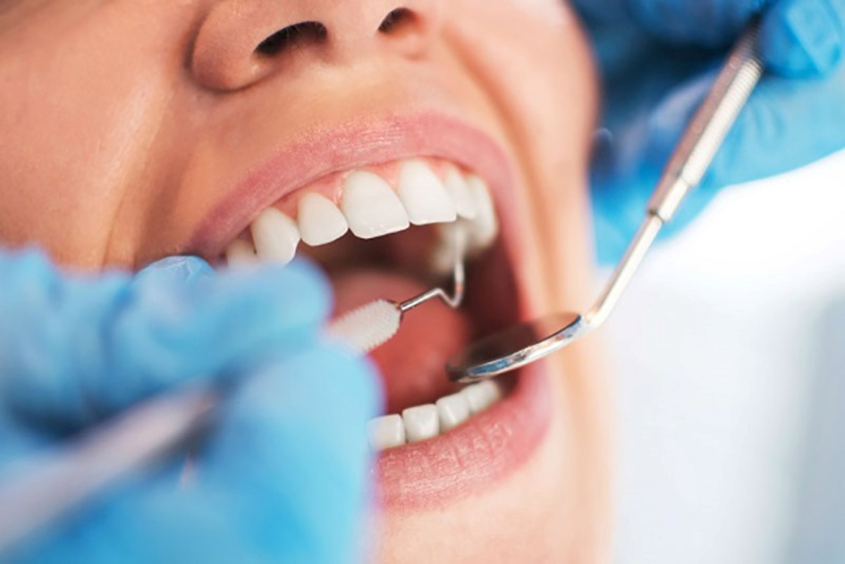 Những cách tẩy cao răng tự nhiên