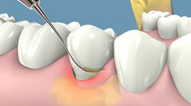 tẩy cao răng tự nhiên