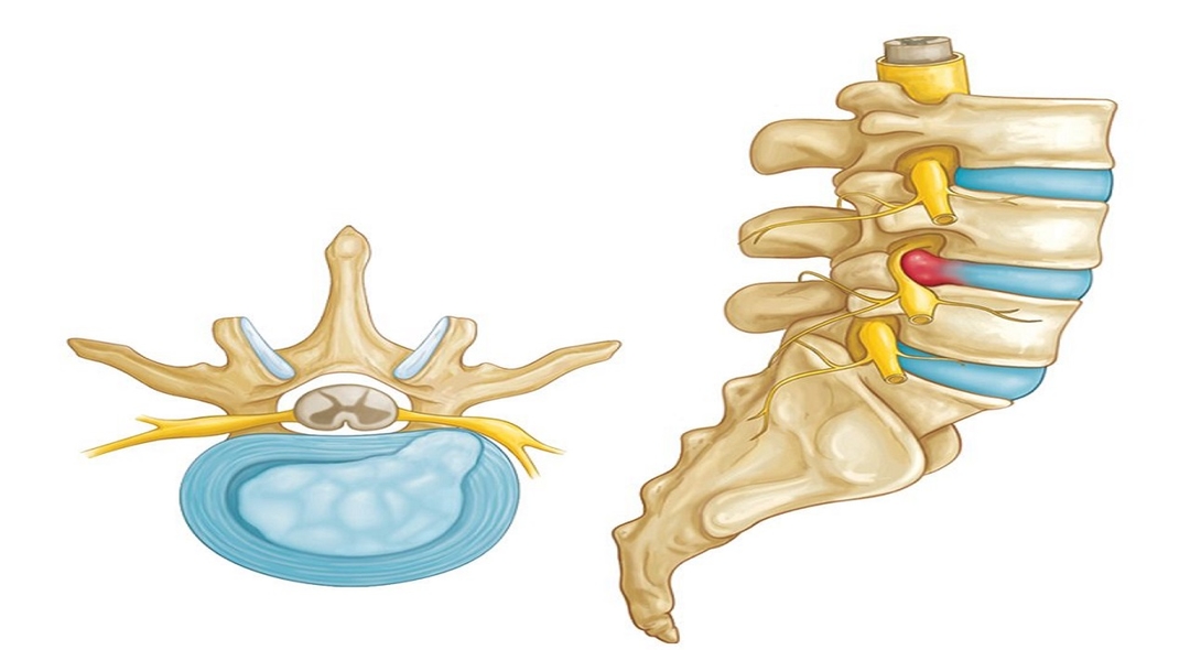 Thoát vị đĩa đệm nguyên nhân và biện pháp phòng ngừa