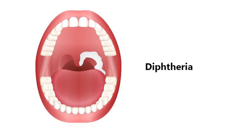 Biến chứng về hô hấp thường gặp nhất ở bệnh nhân bạch hầu