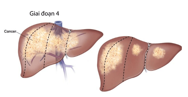 Chi phí xạ trị ung thư gan và những điều cần biết
