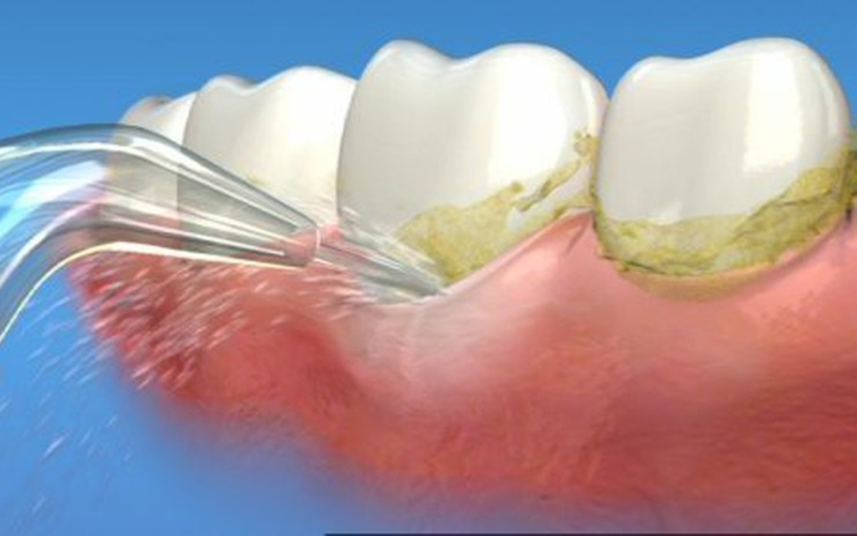3 Cách loại bỏ cao răng tại nhà hiệu quả
