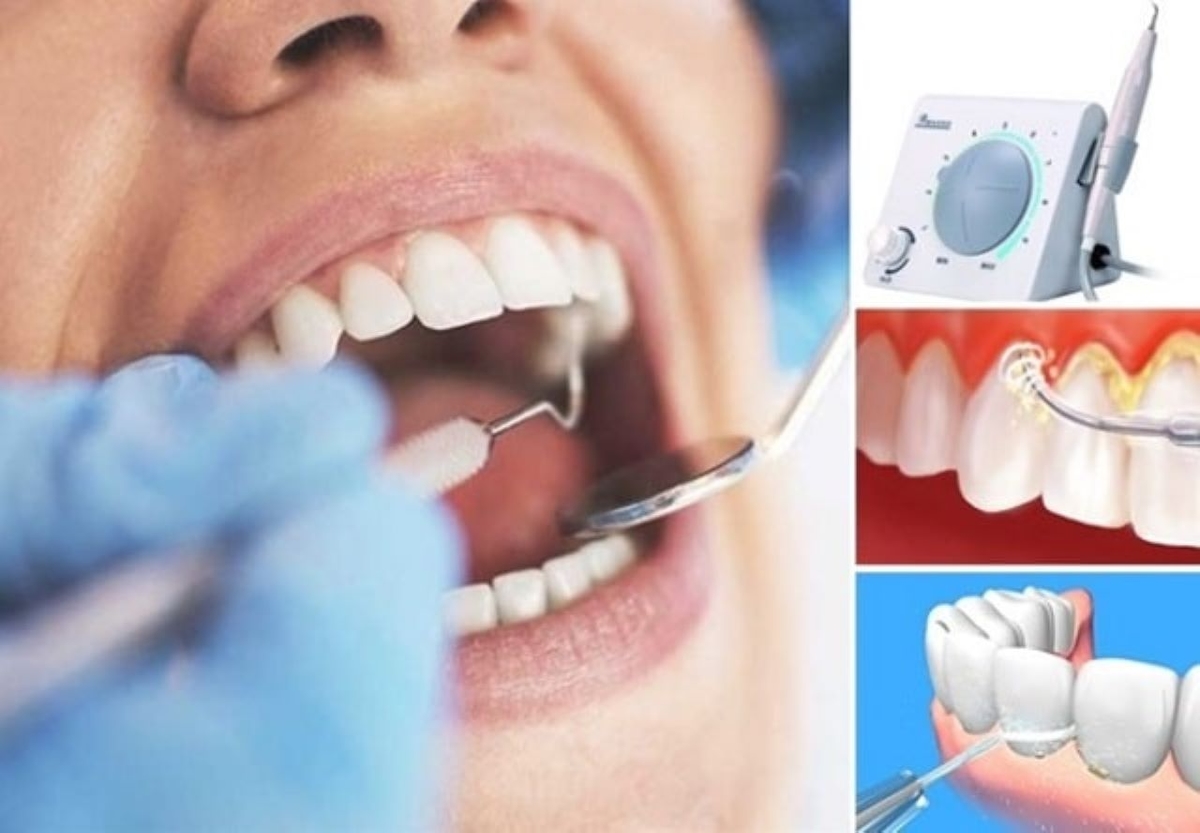 6 Tháng cạo vôi răng 1 lần có thực sự tốt