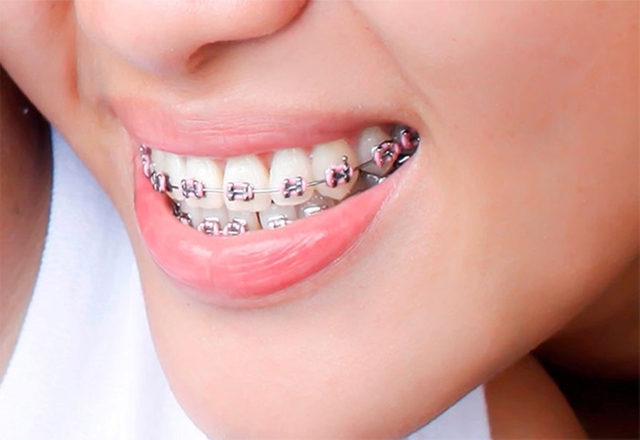 Bảng giá nắn chỉnh răng và các yếu tố tác động