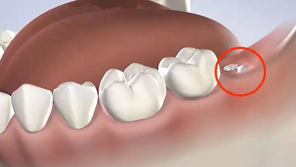 Thời điểm mọc răng không của mỗi người là hoàn toàn khác nhau