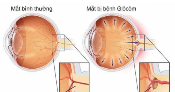 Người có bệnh án glocom nếu được phát hiện và điều trị sớm sẽ cho hiệu quả chữa trị cao hơn.