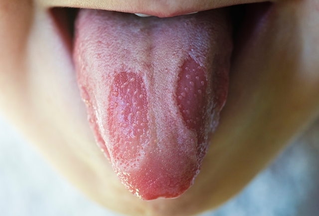Bệnh herpes lưỡi: Nhận biết và điều trị