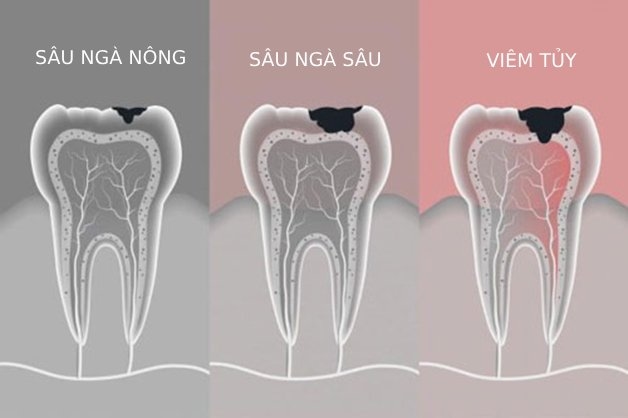 benh sau rang là gì