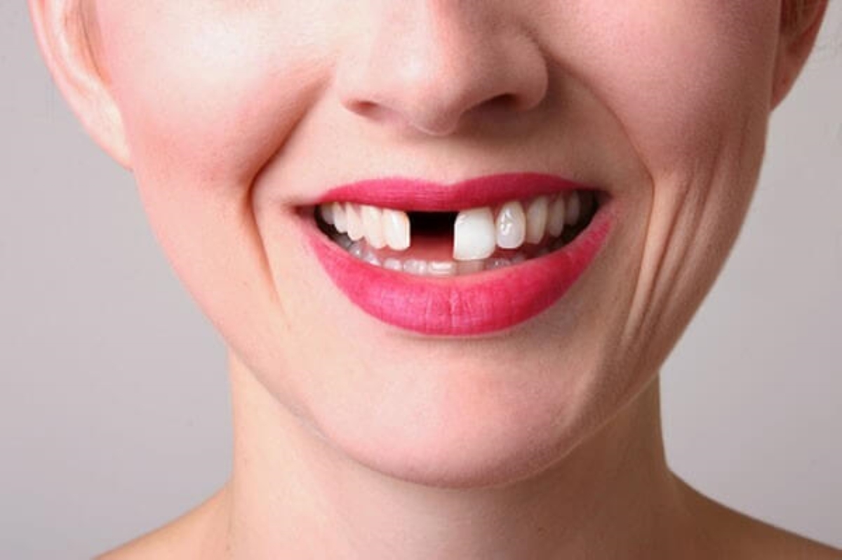 Bị sâu 2 răng cửa và cách điều trị