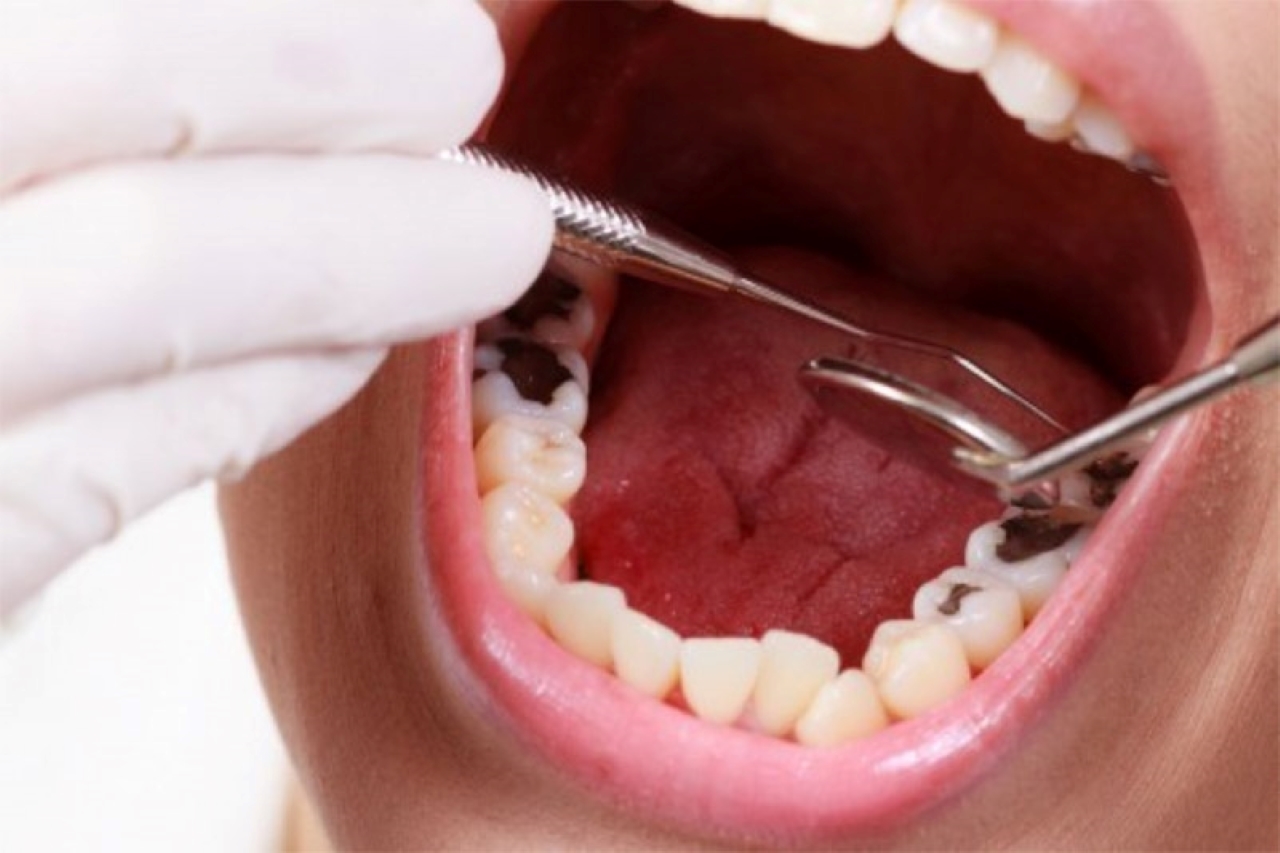 Những việc cần phải làm khi bị sâu răng cấm