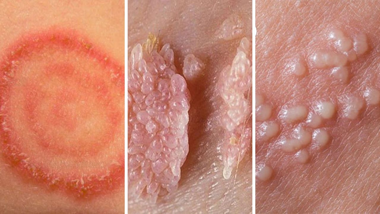 Các bệnh lây qua đường tình dục rất nguy hiểm